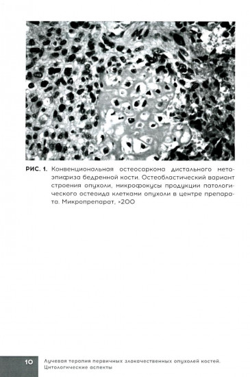 Лучевая терапия первичных злокачественных опухолей костей. Цитологические аспекты