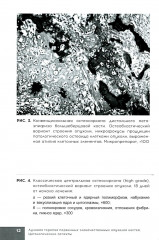 Лучевая терапия первичных злокачественных опухолей костей. Цитологические аспекты - Фото 5