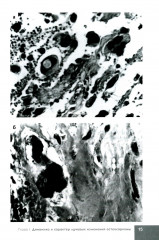 Лучевая терапия первичных злокачественных опухолей костей. Цитологические аспекты - Фото 8