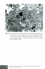 Лучевая терапия первичных злокачественных опухолей костей. Цитологические аспекты - Фото 9
