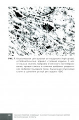 Лучевая терапия первичных злокачественных опухолей костей. Цитологические аспекты - Фото 11