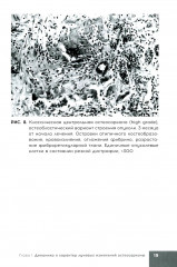 Лучевая терапия первичных злокачественных опухолей костей. Цитологические аспекты - Фото 12