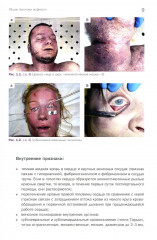 Судебно-медицинская экспертиза механической асфиксии и постасфиктической болезни - Фото 6