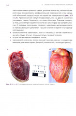 Судебно-медицинская экспертиза механической асфиксии и постасфиктической болезни - Фото 7