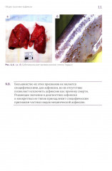 Судебно-медицинская экспертиза механической асфиксии и постасфиктической болезни - Фото 8