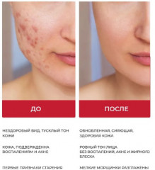 Тоник против черных точек с BHA-кислотой очищающий «Blackhead & Pore Toner» - Фото 1