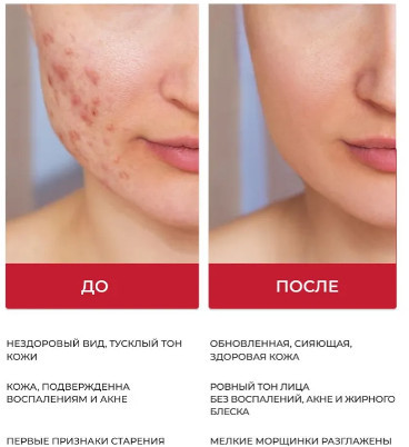 Тоник против черных точек с BHA-кислотой очищающий «Blackhead & Pore Toner»