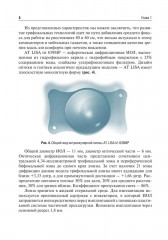Методика интраокулярной коррекции пресбиопии трифокальными интраокулярными линзами - Фото 5