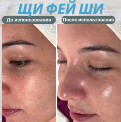 Крем для лица от прыщей и угрей - Фото 4