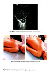 Ультразвуковое исследование легких у детей при пневмонии - Фото 9