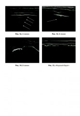 Ультразвуковое исследование легких у детей при пневмонии - Фото 11