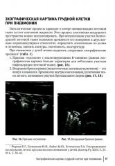 Ультразвуковое исследование легких у детей при пневмонии - Фото 12