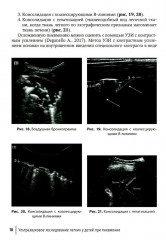Ультразвуковое исследование легких у детей при пневмонии - Фото 13