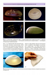 Руководство по ультразвуковому исследованию молочных желез до увеличивающей маммопластики и после нее - Фото 3