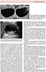 Стандартизация ультразвукового исследования патологии придатков матки по IOTA, O-RADS - Фото 3