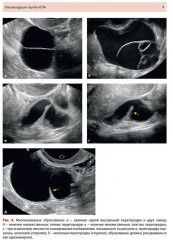 Стандартизация ультразвукового исследования патологии придатков матки по IOTA, O-RADS - Фото 4