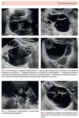 Стандартизация ультразвукового исследования патологии придатков матки по IOTA, O-RADS - Фото 5