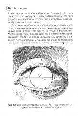 Астигматизм - Фото 13