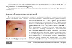 Симптомы и синдромы в офтальмологии - Фото 14