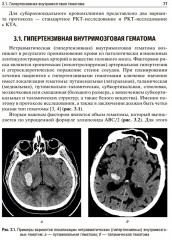 Ишемический инсульт и нетравматическое внутричерепное кровоизлияние. Формализованные протоколы описания РКТ- и МРТ-исследований - Фото 6