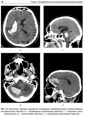 Ишемический инсульт и нетравматическое внутричерепное кровоизлияние. Формализованные протоколы описания РКТ- и МРТ-исследований - Фото 7