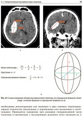 Ишемический инсульт и нетравматическое внутричерепное кровоизлияние. Формализованные протоколы описания РКТ- и МРТ-исследований - Фото 8