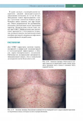 Клиническая дерматология. Акнеподобные и папулосквамозные дерматозы - Фото 10