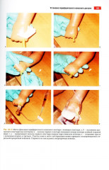 Атлас манипуляций в неонатологии - Фото 6