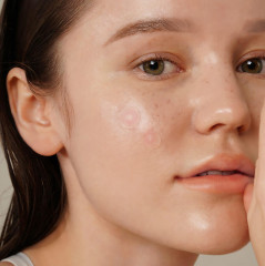 Точечные патчи от воспалений с красным луком успокаивающие «Onion Newpair Spot Patch Basic» - Фото 3