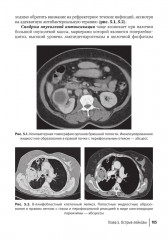 Лучевая диагностика при заболеваниях системы крови - Фото 8