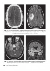 Лучевая диагностика при заболеваниях системы крови - Фото 11