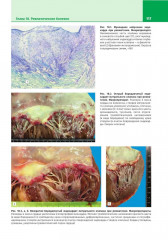Патологическая анатомия. Атлас. Том 2. Частная патологическая анатомия - Фото 6