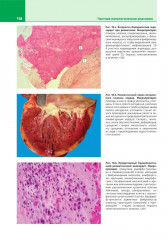 Патологическая анатомия. Атлас. Том 2. Частная патологическая анатомия - Фото 7