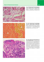 Патологическая анатомия. Атлас. Том 2. Частная патологическая анатомия - Фото 8