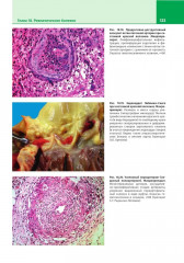 Патологическая анатомия. Атлас. Том 2. Частная патологическая анатомия - Фото 12
