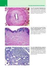 Патологическая анатомия. Атлас. Том 2. Частная патологическая анатомия - Фото 13