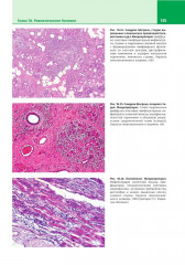 Патологическая анатомия. Атлас. Том 2. Частная патологическая анатомия - Фото 14