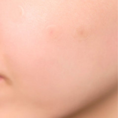 Патчи для лица от воспалений «Spot Cover Patch» - Фото 5