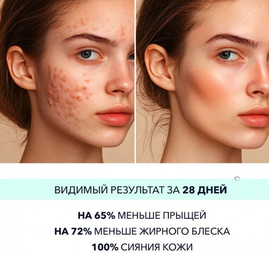 Сыворотка для лица «Salicylic Acid Acne Removal»