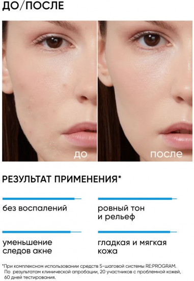 Пилинг для проблемной кожи «Anti-Acne Smart Peel System 11%»