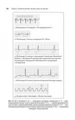 Карманный справочник по ЭКГ - Фото 12