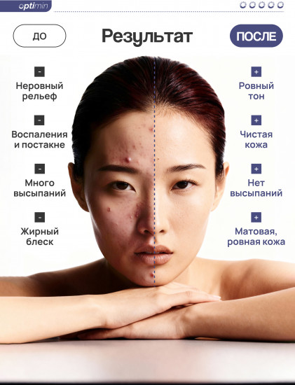 Крем от акне