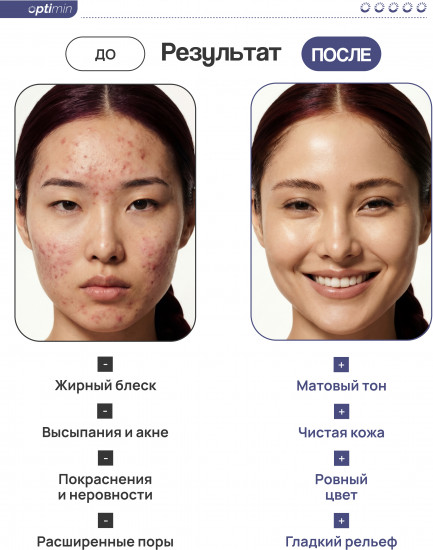 Сыворотка для лица против акне