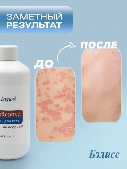 Лечебный гель для тела от псориаза