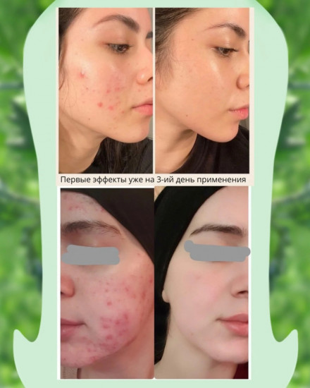 Глиняная маска в стике от черных точек и расширенных пор