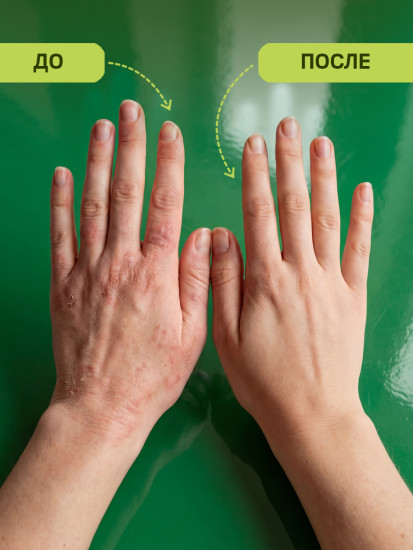 Мазь от псориаза, экземы и дерматита «Сокровище рыбака»