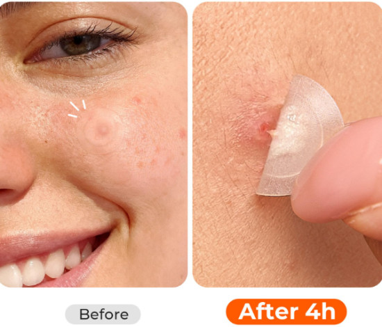 Успокаивающие патчи от прыщей, покраснений и постакне
