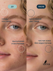 Средство точечного нанесения №35 «Anti-acne» - Фото 2