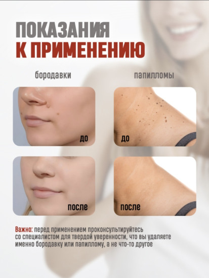 Средство для удаления бородавок, родинок и папиллом