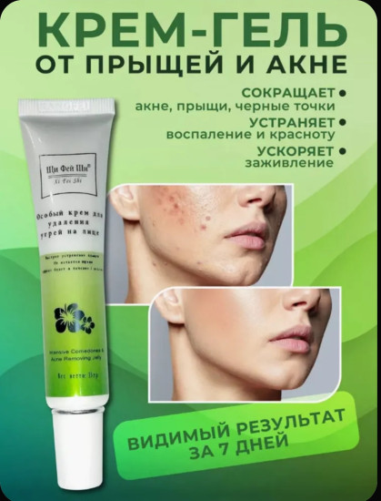 Крем для лица от прыщей и угрей